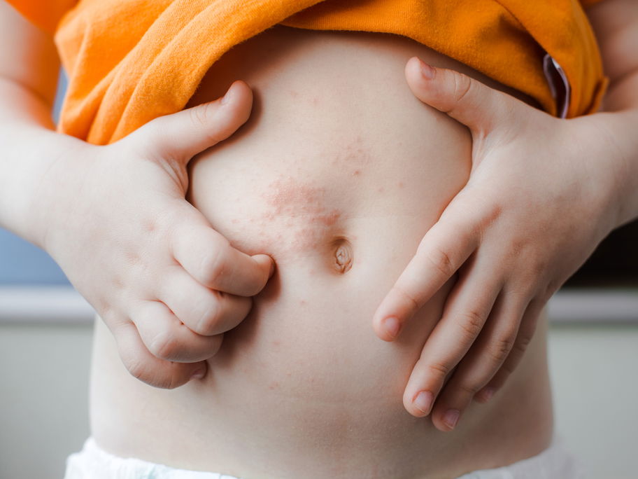 Eine Junge hat einen Hauttausschlag am Bauch.