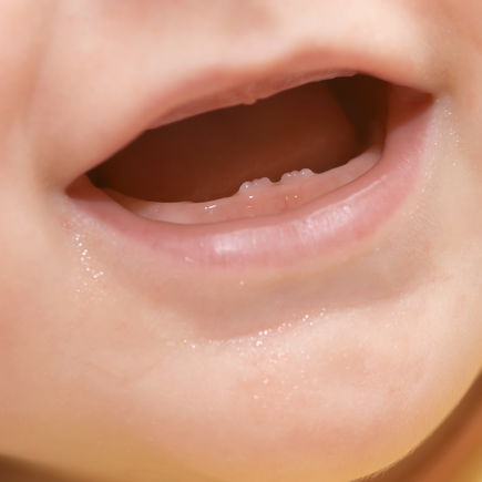 Schon mal gesehen? Baby mit zwei Hexenzähnen geboren