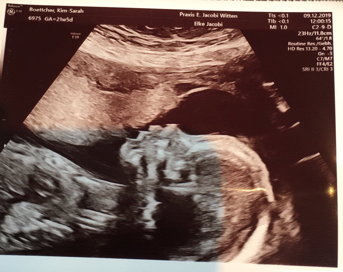 Ultraschallbild von Greta – sie hat das Williams-Beuren-Syndrom