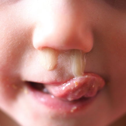 Gelb-grüner Schnupfen bei Kindern? Experten verraten, was das bedeutet