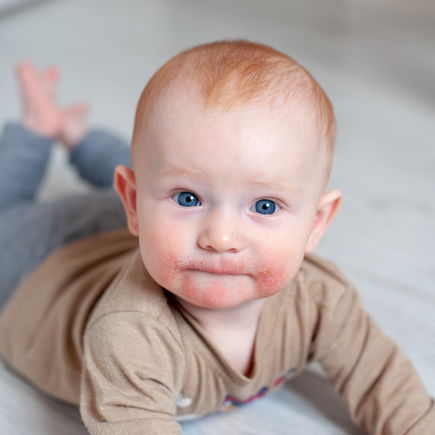 Zahnungsausschlag beim Baby: Was wirklich hilft