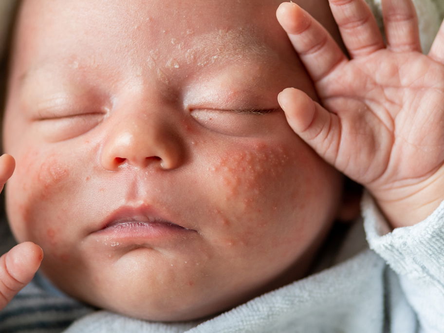Baby mit Neugeborenenakne.