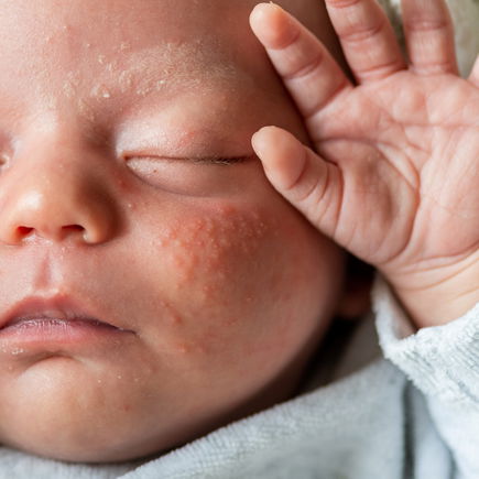 Babyakne: Woher sie kommt und was hilft