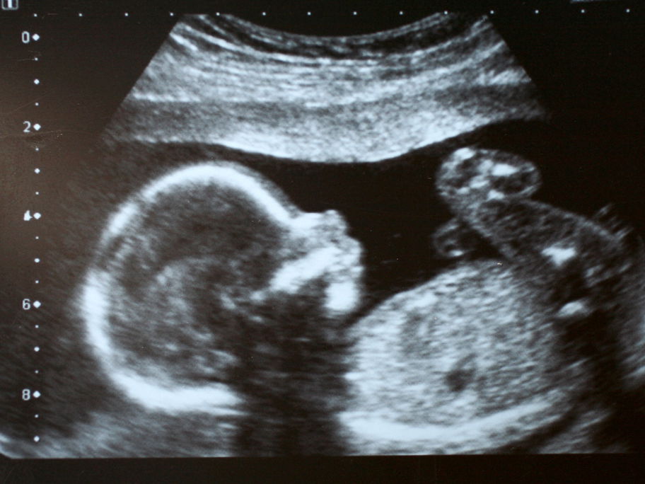 Ultraschallbild eines Babys.