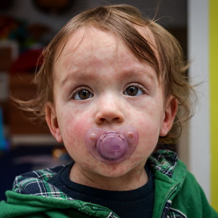 Extremer Anstieg bei Masern-Infektionen! Warum die Kinder-Krankheit so gefährlich ist