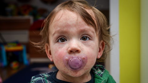 Extremer Anstieg bei Masern-Infektionen! Warum die Kinder-Krankheit so gefährlich ist