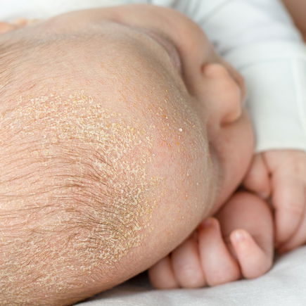 Kopfgneis beim Baby – wie behandeln?