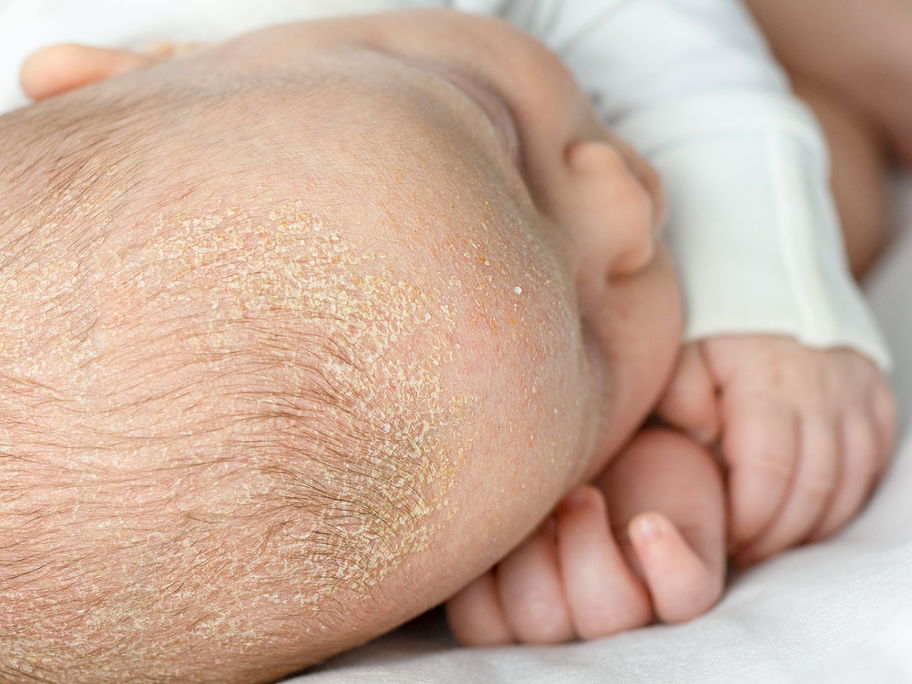 Babykopf mit Kopfgneis