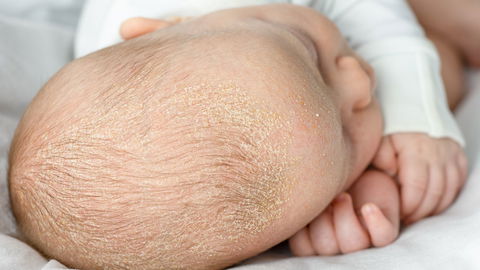 Kopfgneis beim Baby – wie behandeln?
