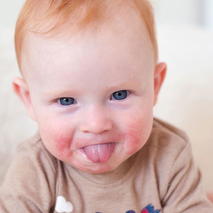 Achtung Allergien – schon bei Babys