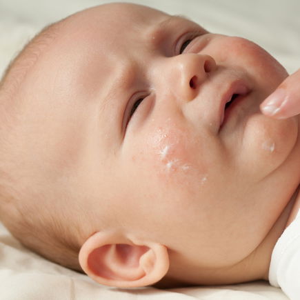 Neurodermitis bei Babys und Kindern: Was hilft?