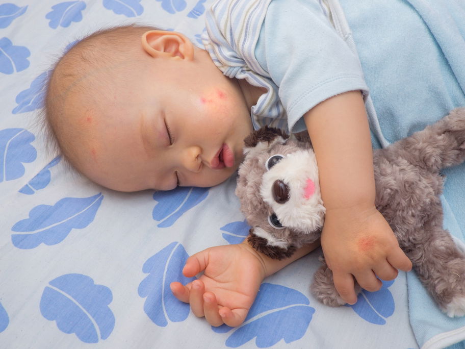 Schlafendes Baby mit Mückenstichen im Gesicht.