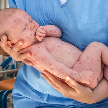 Warum Herpes beim Baby lebensgefährlich sein kann