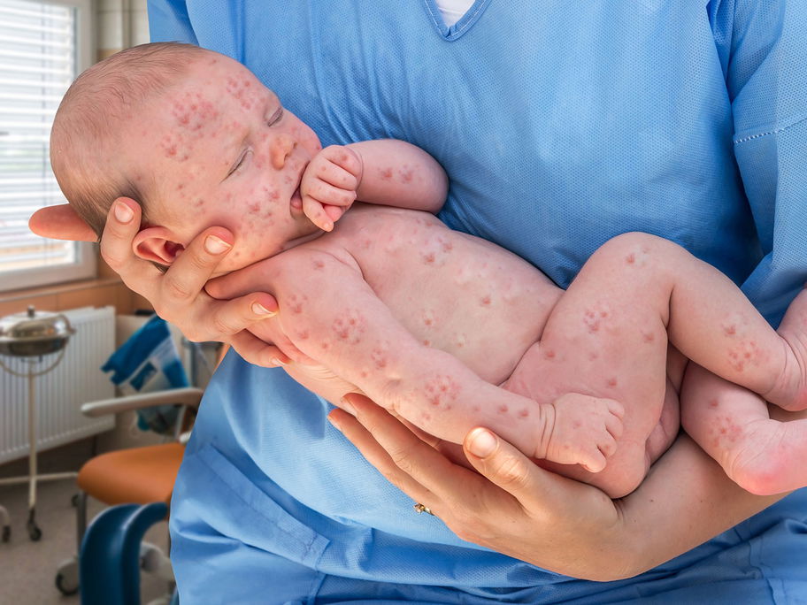 Ein heftiger Herpes-Ausbruch kann für Babys lebensgefährlich sein.