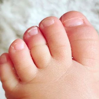 Tourniquet-Syndrom beim Baby: Wenn ein Haar den Zeh abschnürt