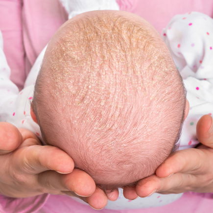 Milchschorf bei Babys – woher kommt er?
