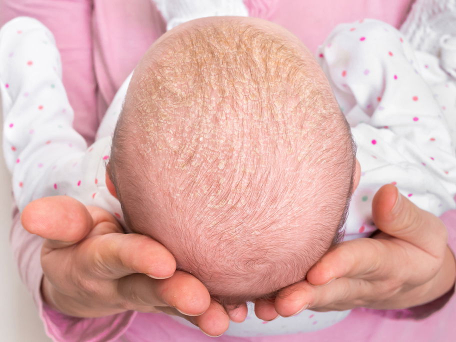 Kopf eines Babys mit Milchschorf