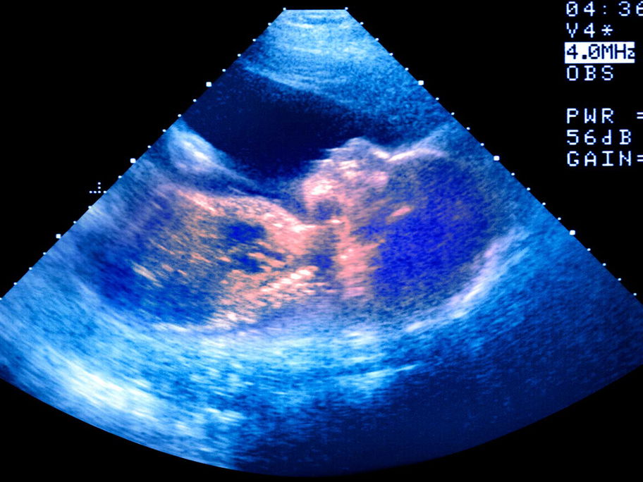 Ein Ultraschallbild, auf dem die Umrisse eines Babys zu erkennen sind