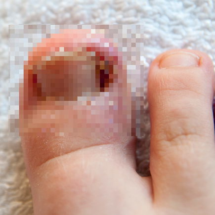 Wann müssen Kinder mit einem eingewachsenen Zehnagel zum Arzt?