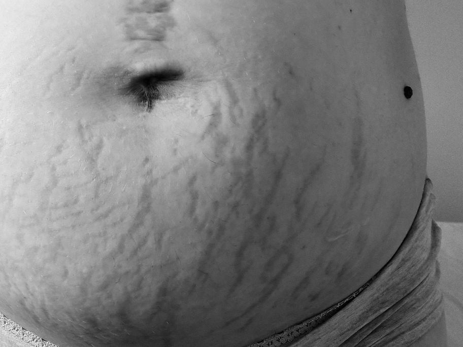 Bauch nach der Geburt