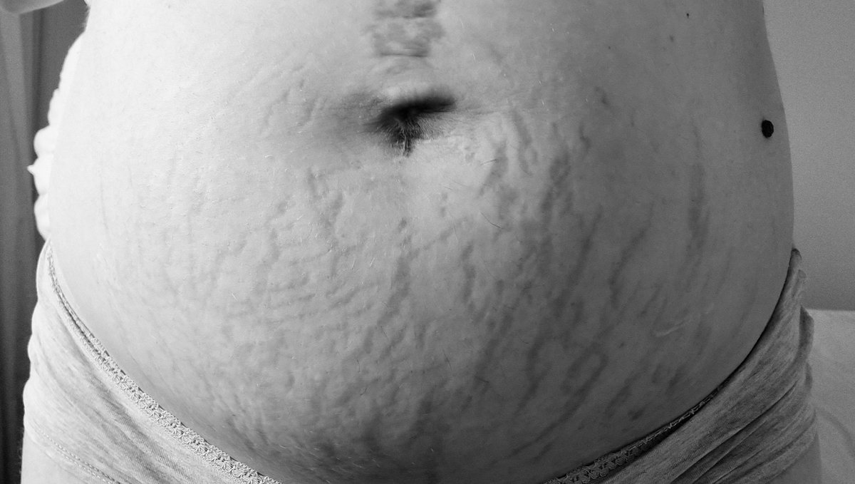 Bauch nach der Geburt