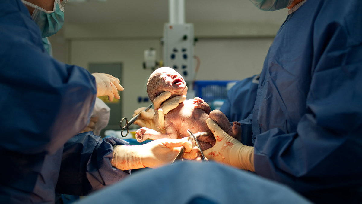 Ärzte im OP halten Baby direkt nach dem Kaiserschnitt.