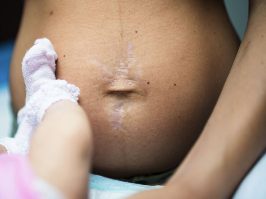 Aus bestimmten Gründen ist es gar nicht möglich, dass der Bauch nach der Geburt gleich wieder flach ist.